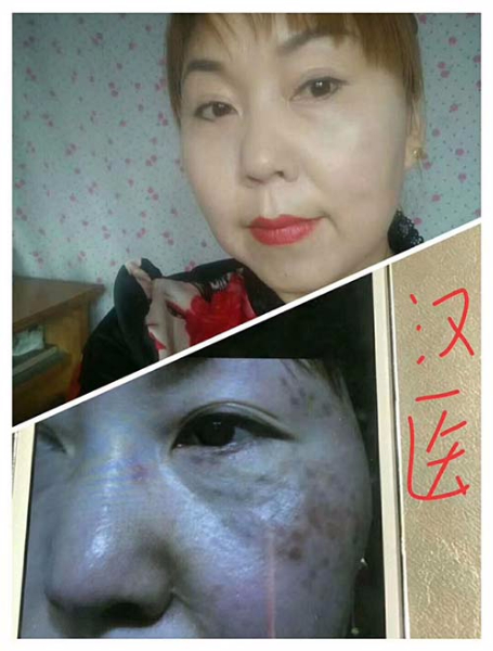 純中藥祛斑代理加盟招商